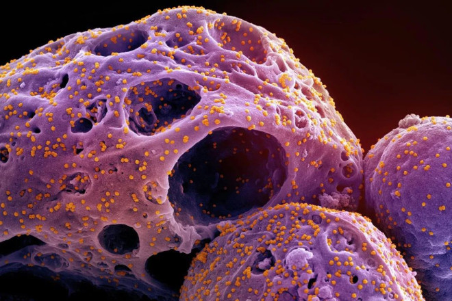 A colorized electron microscope image, in November 2022, shows cells, indicated in purple, infected with the Omicron strain of the SARS-CoV-2 virus, orange.
